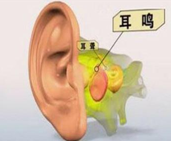 上海企仁 听力筛查仪帮你梳理耳鸣和心理反应的关系